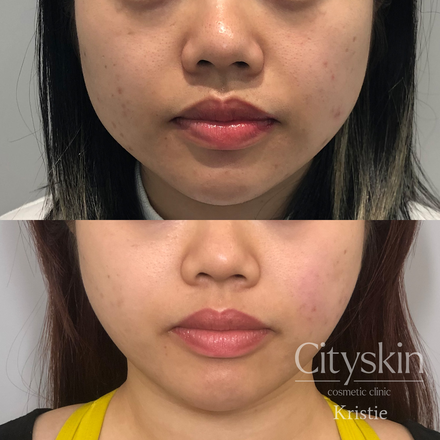 AW, facial slimming masseter -Before and After