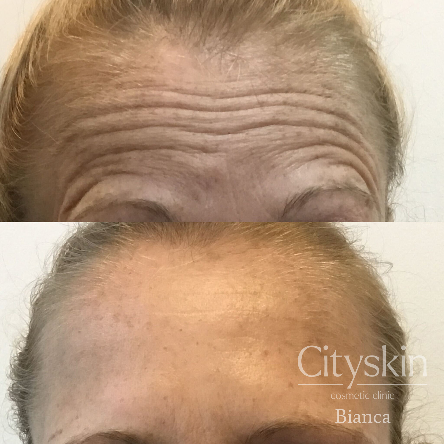 Anti-wrinkle Forehead_Bianca