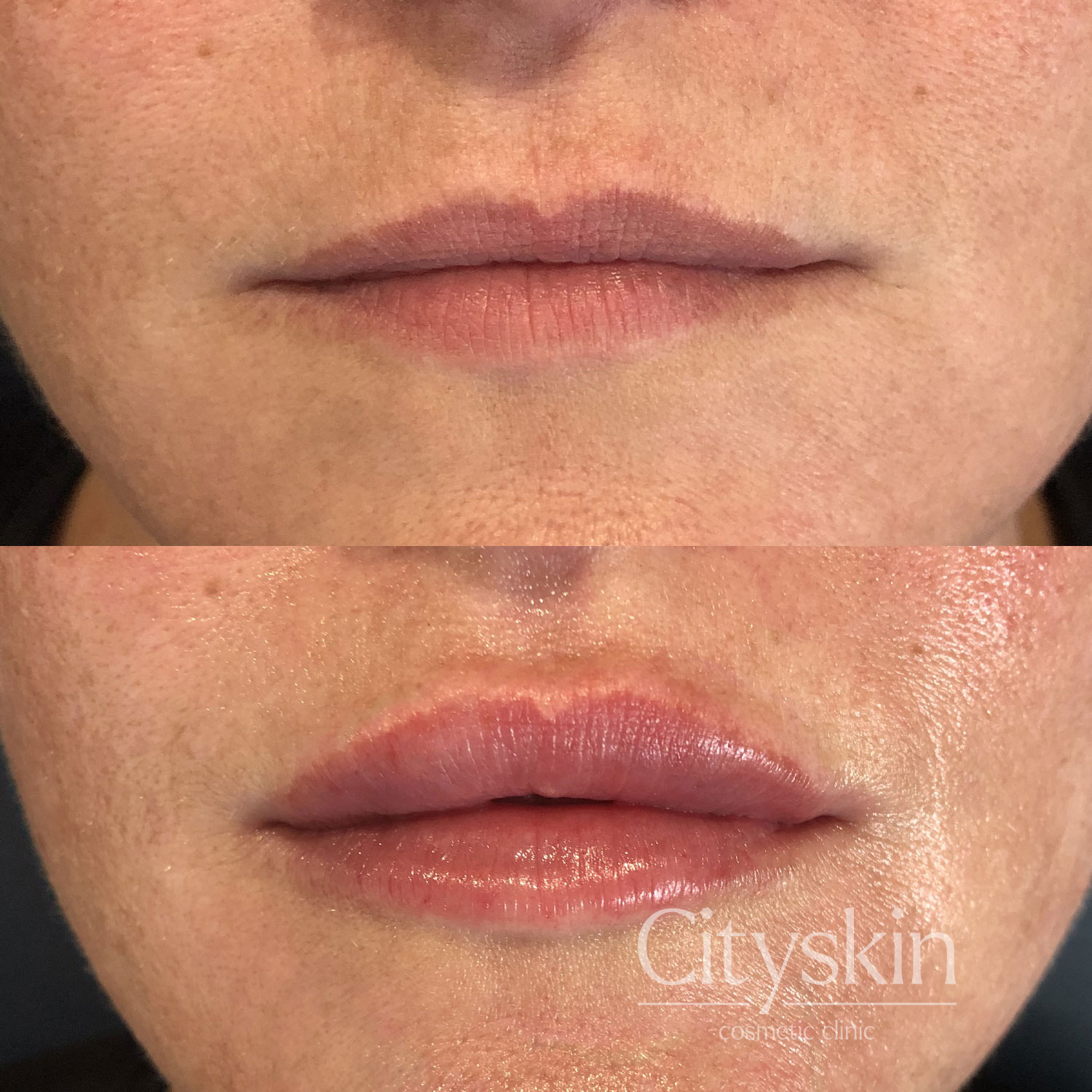Lip-Dermal-Filler-Before-and-After