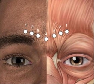 anti-wrinkle injections diagram
