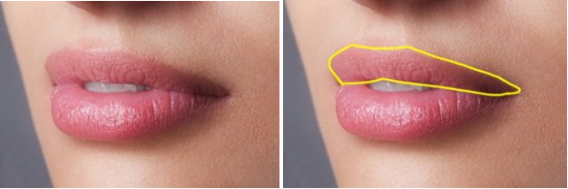 Which Injectable Fillers Are Best for M Shaped Lips?