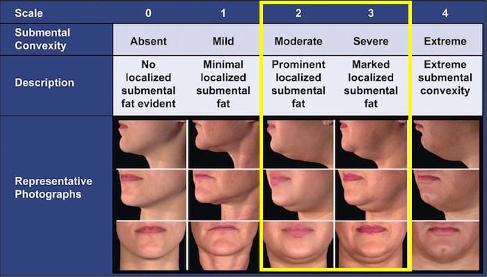 double chin removal treatment guide