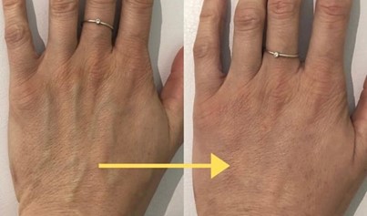 Hand dermal filler before / after at Cityskin