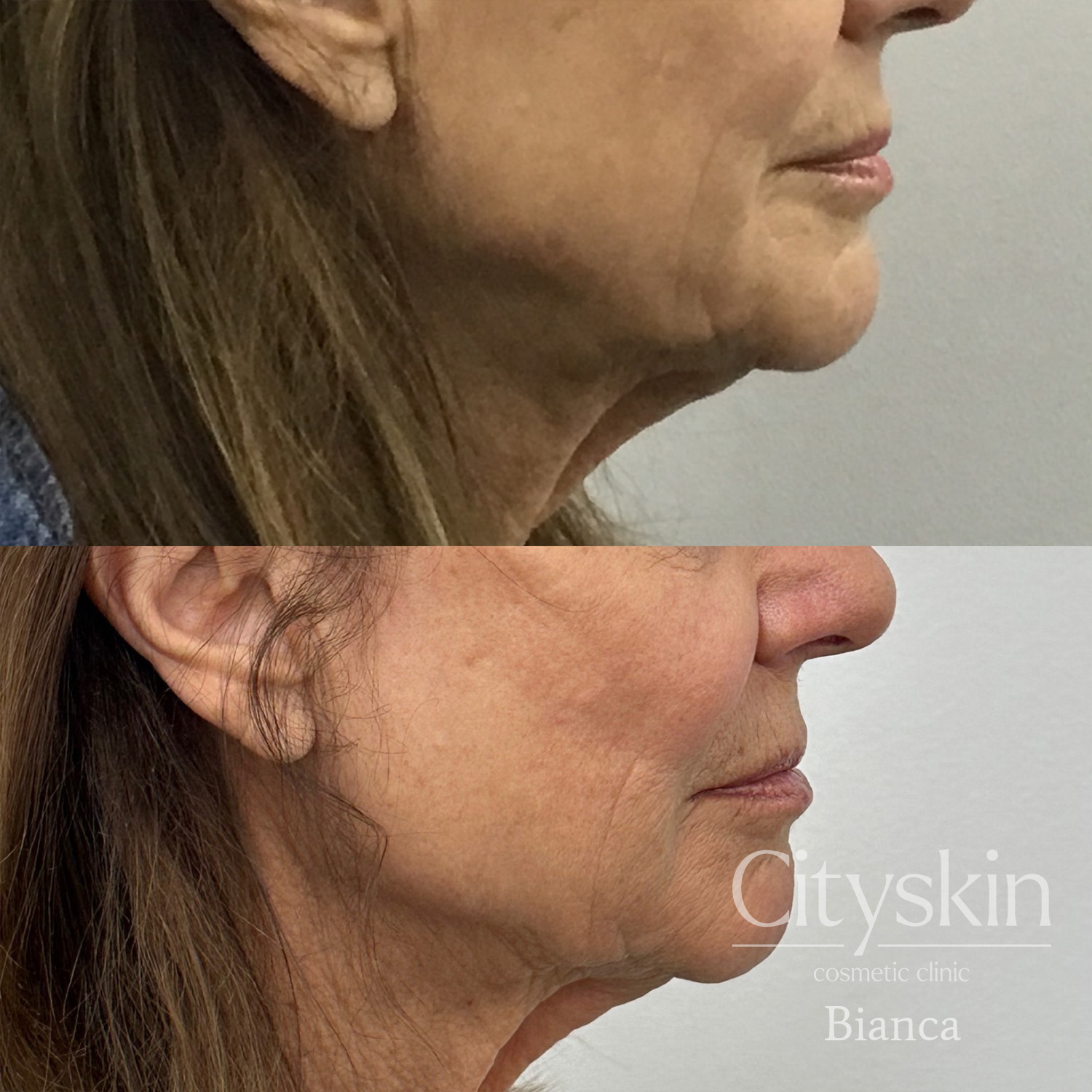 Dermal Filler, Lower Facial Rejuvenation, Bianca 1 - Bianca